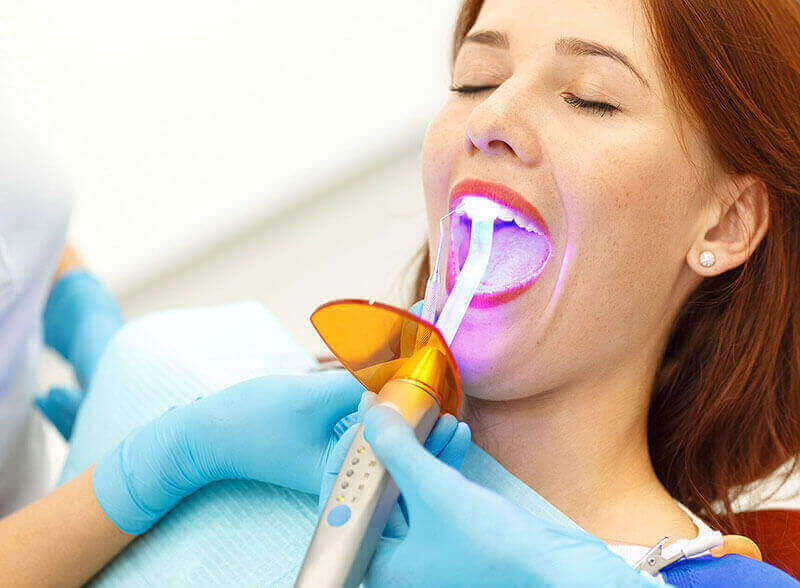 Dental Bonding Dryden