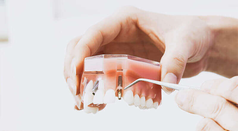 Dental Implants Dryden