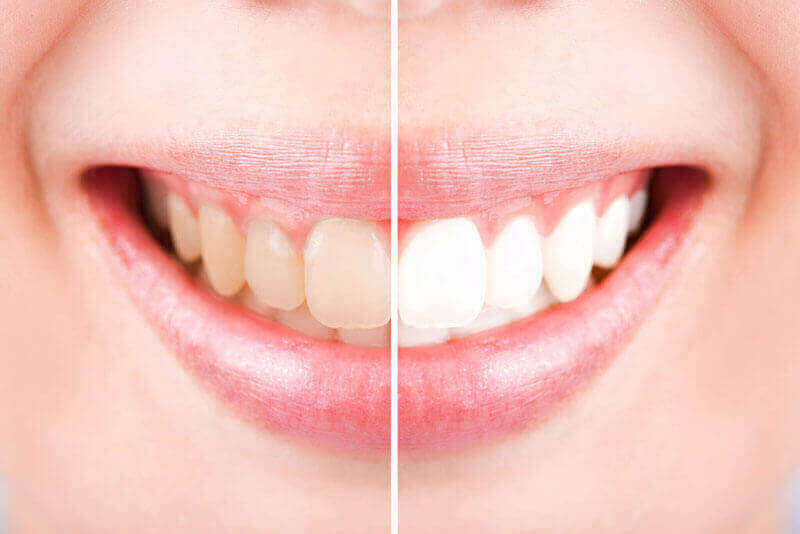 Teeth Whitening Dryden